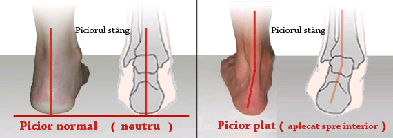 dureri de genunchi picior plat