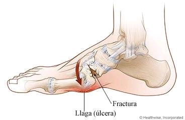 tratamentul osteoartrozei articulației umărului 2 grade hemartroza medicamentelor pentru tratamentul articulațiilor genunchiului