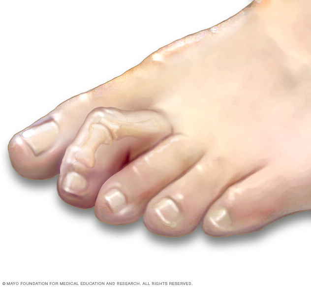 tratamentul artritei deformante a degetelor de la picioare
