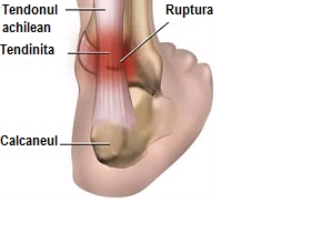 dureri musculare peste genunchi