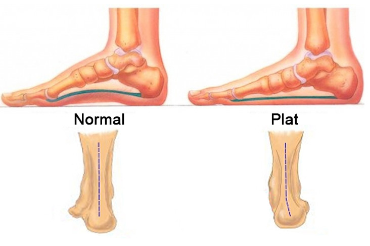 picioare plate și durere în articulațiile piciorului