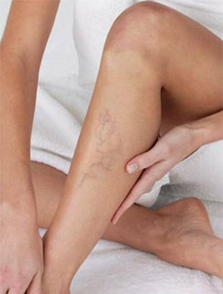 bruisies pe picioare din cauza varicelor varicose recenzii după operații