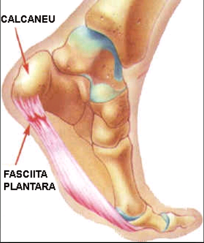 artroza cu picioarele plane a genunchiului
