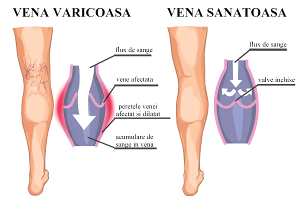 arjuna cu vene varicoase