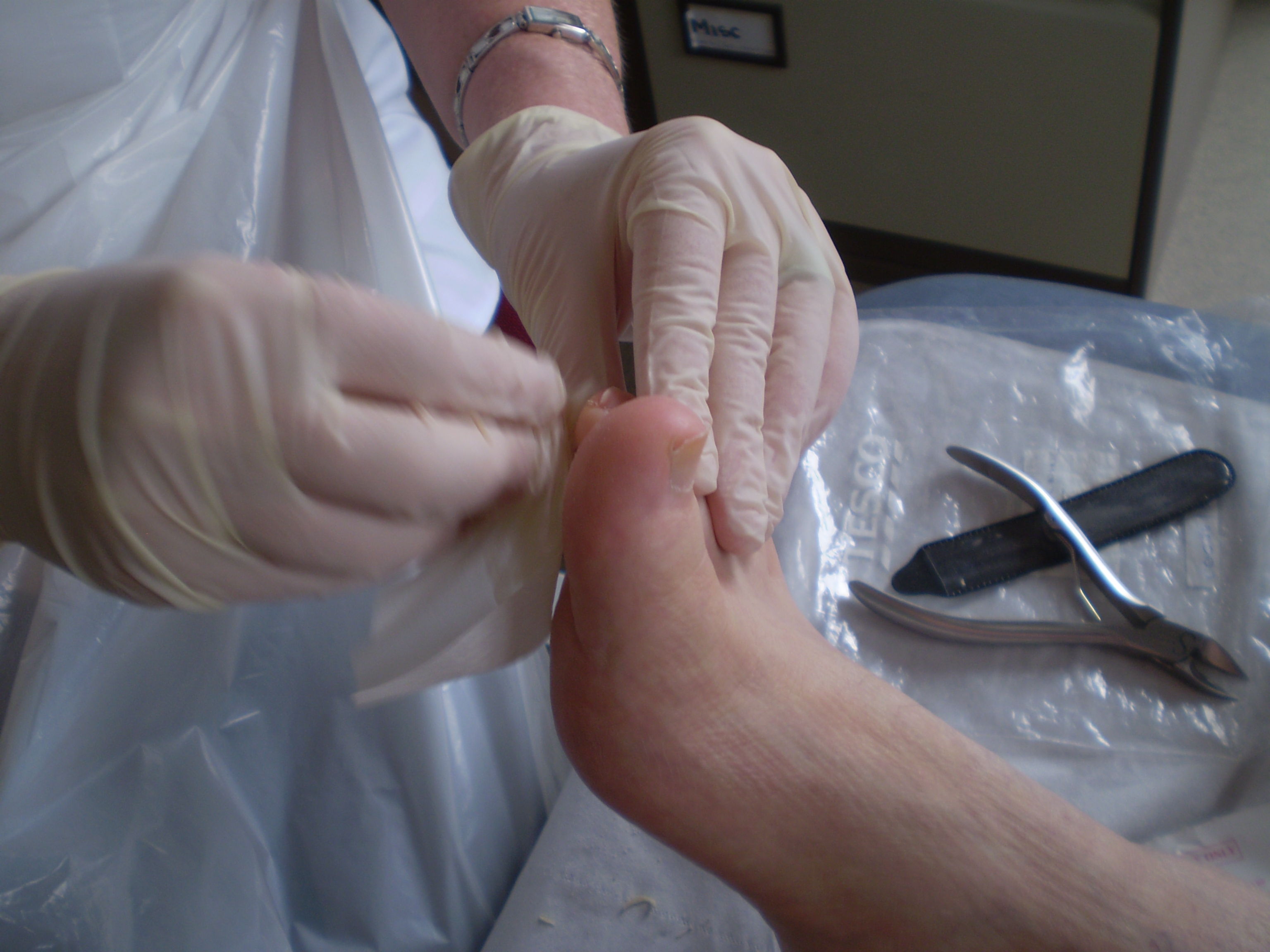 Unghie incarnata - interventia specialistului podolog la un picior cu unghie incarnata
