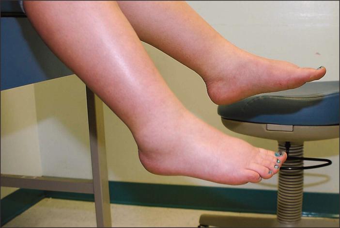 umflarea picioarelor în timpul sarcinii datorita varicelor)