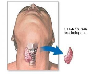 Tiroidectomie_-_procedura_ro